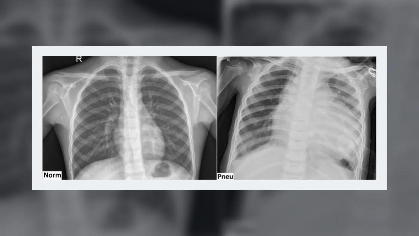 Chest X-ray samples from the published pneumonia CNN research